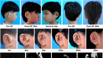 Five Chinese Children Get Lab-Made Ears Grown From Their Own Cells
