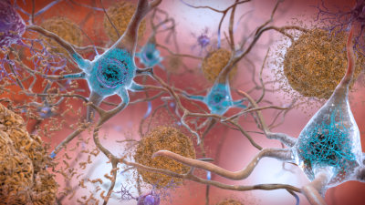 Experts Want To Redefine Alzheimer’s Disease So They Can Study It Better