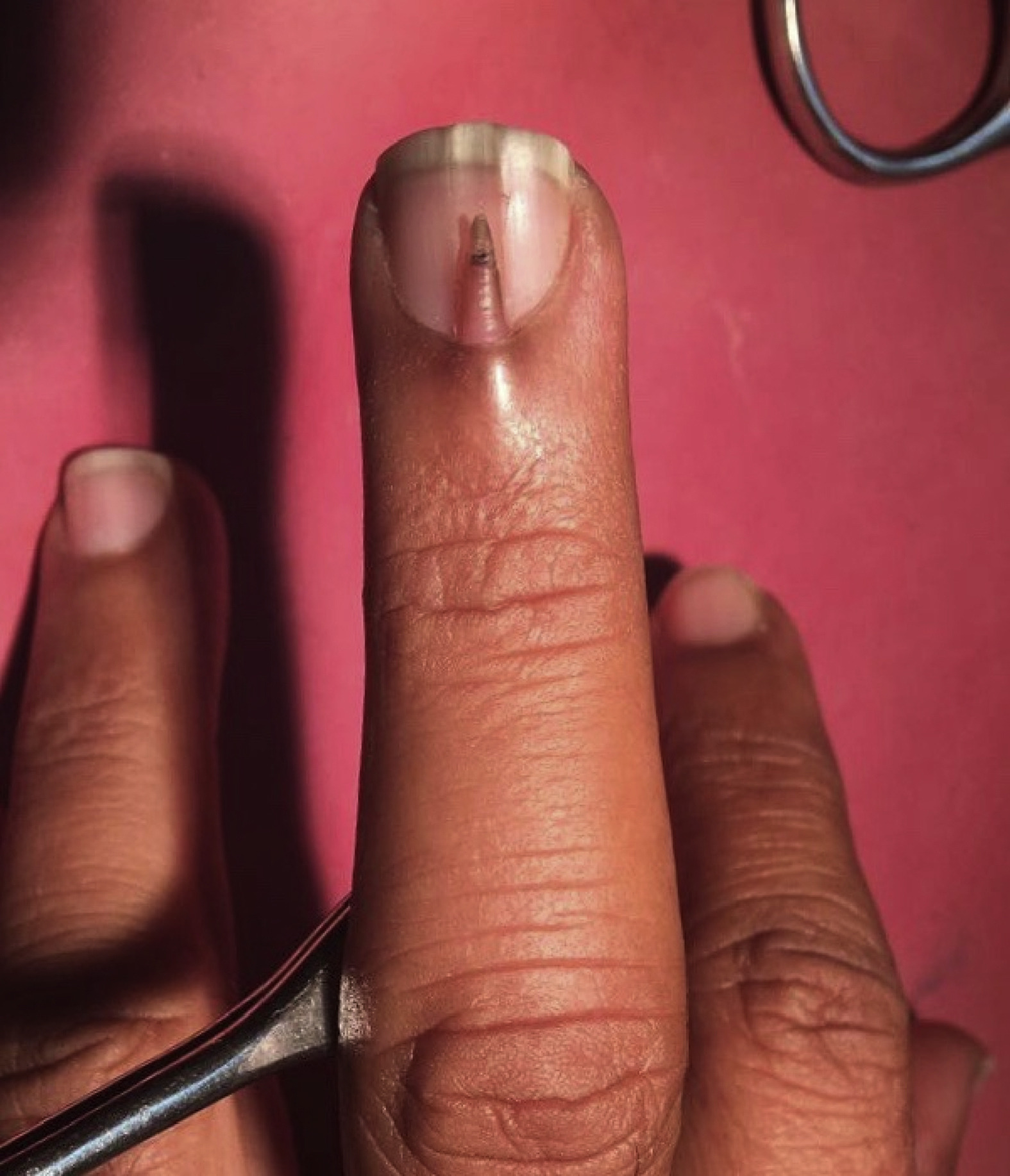 Here Is A Teeny Nail Growing On Top Of Another Nail On Someone’s Middle Finger