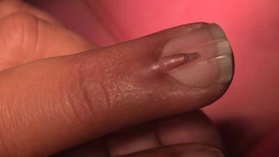 Here Is A Teeny Nail Growing On Top Of Another Nail On Someone’s Middle Finger