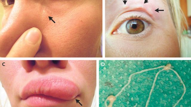 This Woman’s Horrifying Selfies Helped Track The Parasitic Worm Crawling In Her Face