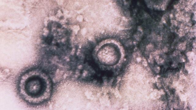 Yet More Evidence That Viruses May Cause Alzheimer’s Disease