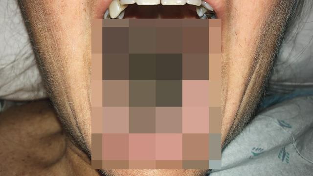 Bizarre Reaction To Antibiotics Gave Woman ‘Black Hairy Tongue’