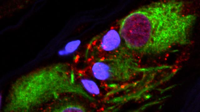 Scientists Find Link Between Parkinson’s Disease And The Appendix