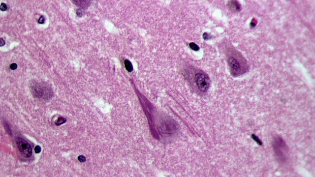 Alzheimer’s Disease Might Develop Differently In Some African Americans, Study Suggests