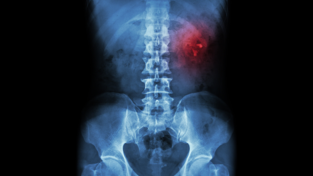 New Online Tool Can Predict If You’ll Have Another Kidney Stone