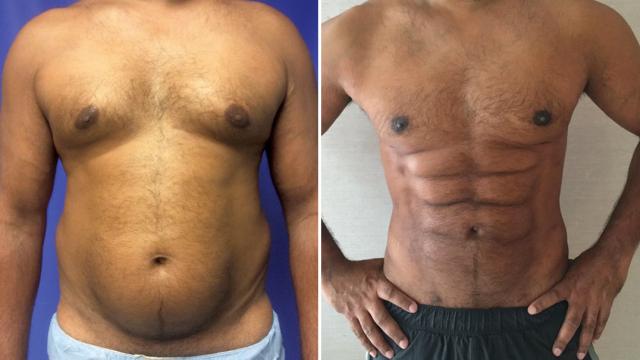Skip The Gym, Plastic Surgeons Can Now Sculpt Belly Fat Into A Weird Chiselled Six-Pack