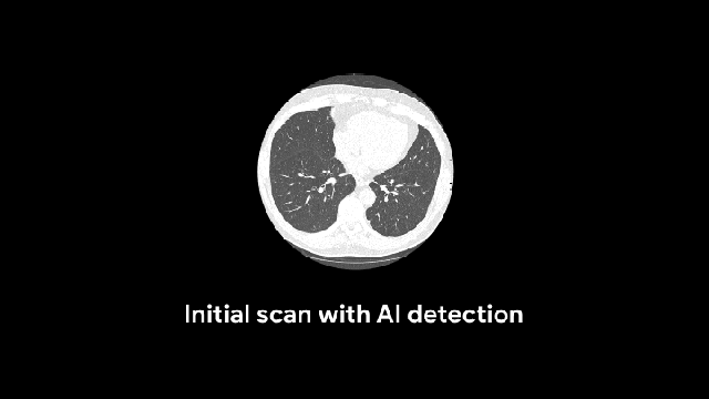 Google Researchers Trained An Algorithm To Detect Lung Cancer Better Than Radiologists