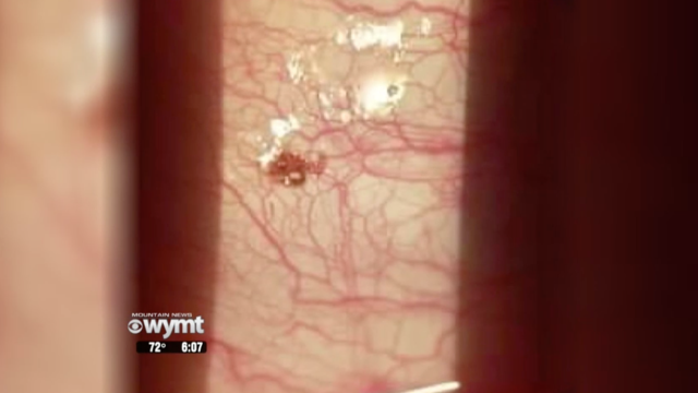 Tick Lodged On Man’s Eyeball Made ‘Popping Sound’ When Doctor Pulled It Off