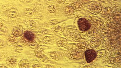 A Chlamydia Vaccine Shows Promise In Early Human Trial