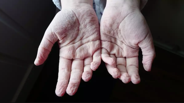 Why Do Our Fingers And Toes Get Wrinkly in The Bath?