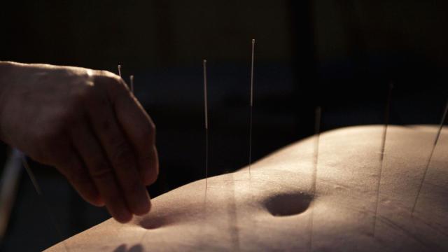 Acupuncturist Went Too Deep, Punctured Patient’s Lungs