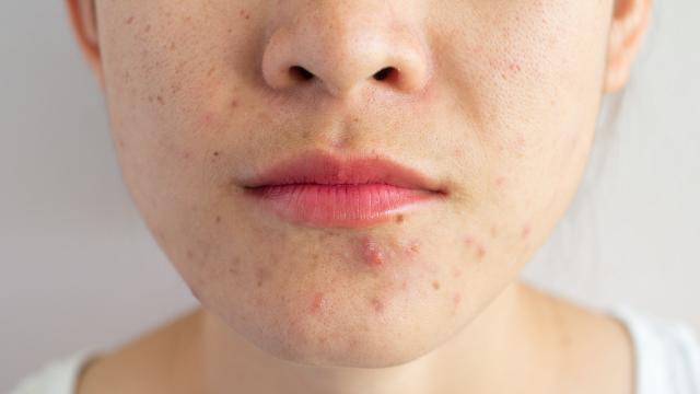 Scientists Still Don’t Really Know What Causes Acne