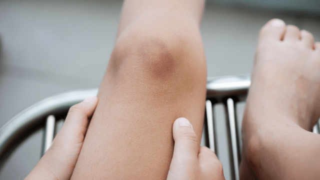 Why Do We Get Bruises?