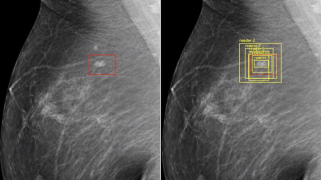 Google’s AI Proves Better At Detecting Breast Cancer Than Doctors
