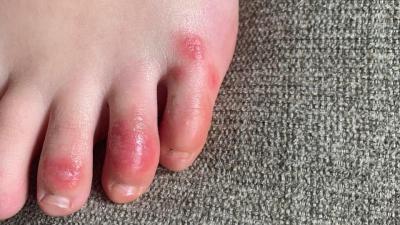 Dermatologists Report Odd Toe Symptoms Potentially Linked To Covid-19