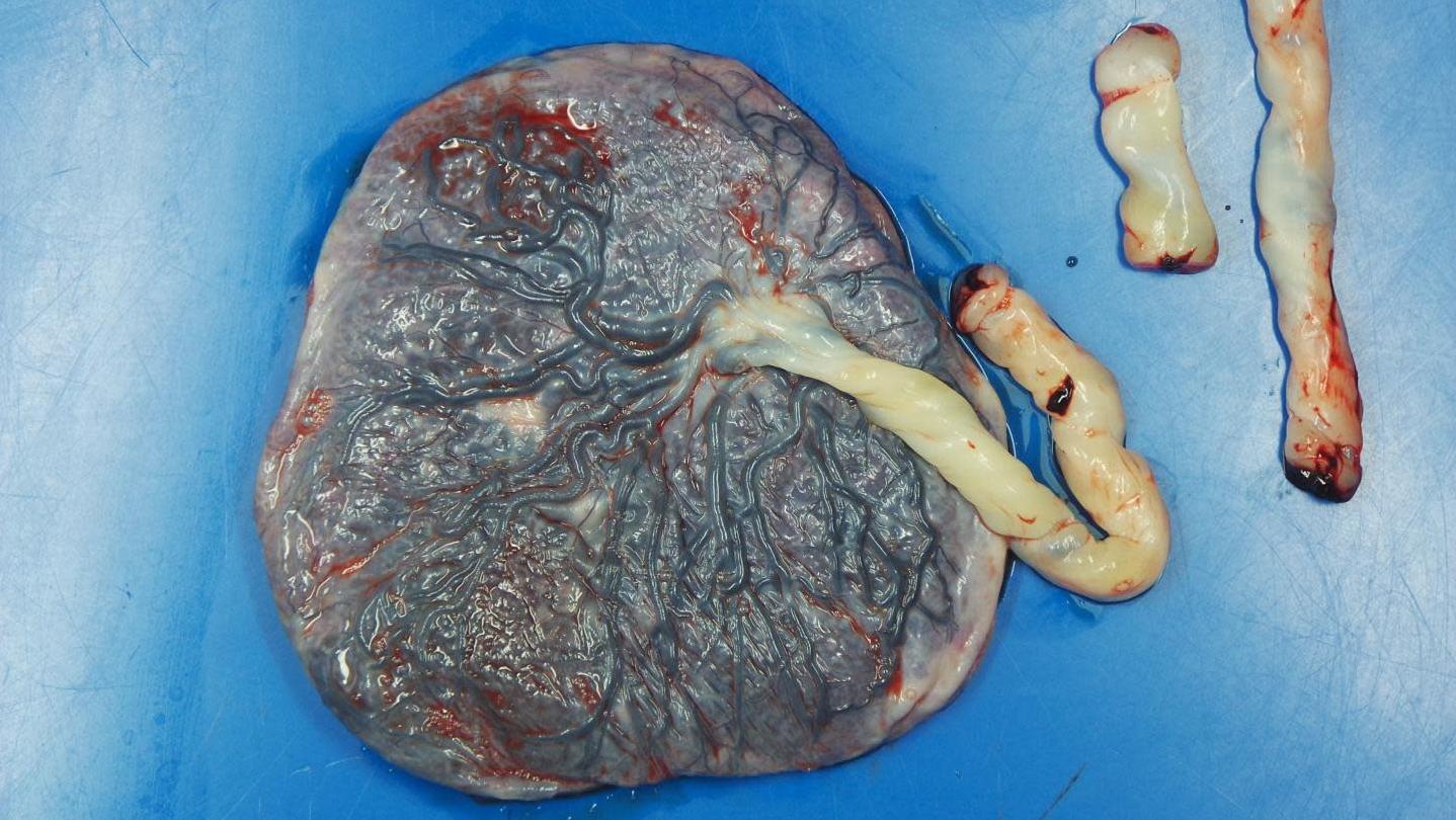 A placenta taken from a women who contracted covid-19. Researchers found that infected women had a greater risk of blood flow problems in their placenta, which could be harmful to their pregnancy.  (Photo: Northwestern University)