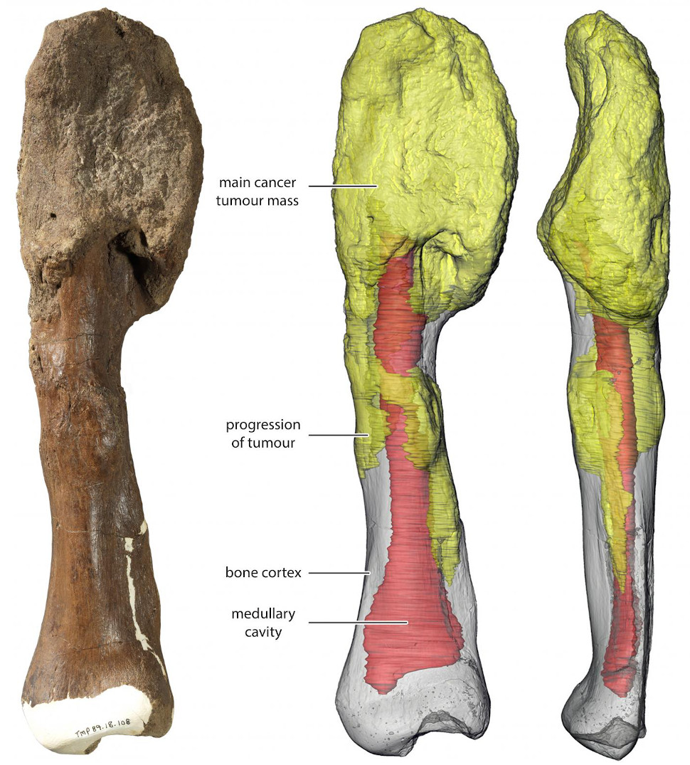 The main tumour mass is at the top of the bone, and can be seen on the 3D reconstruction in yellow; red grey is the normal bone and red denotes the medullary cavity. (Image:  Royal Ontario Museum/McMaster University)