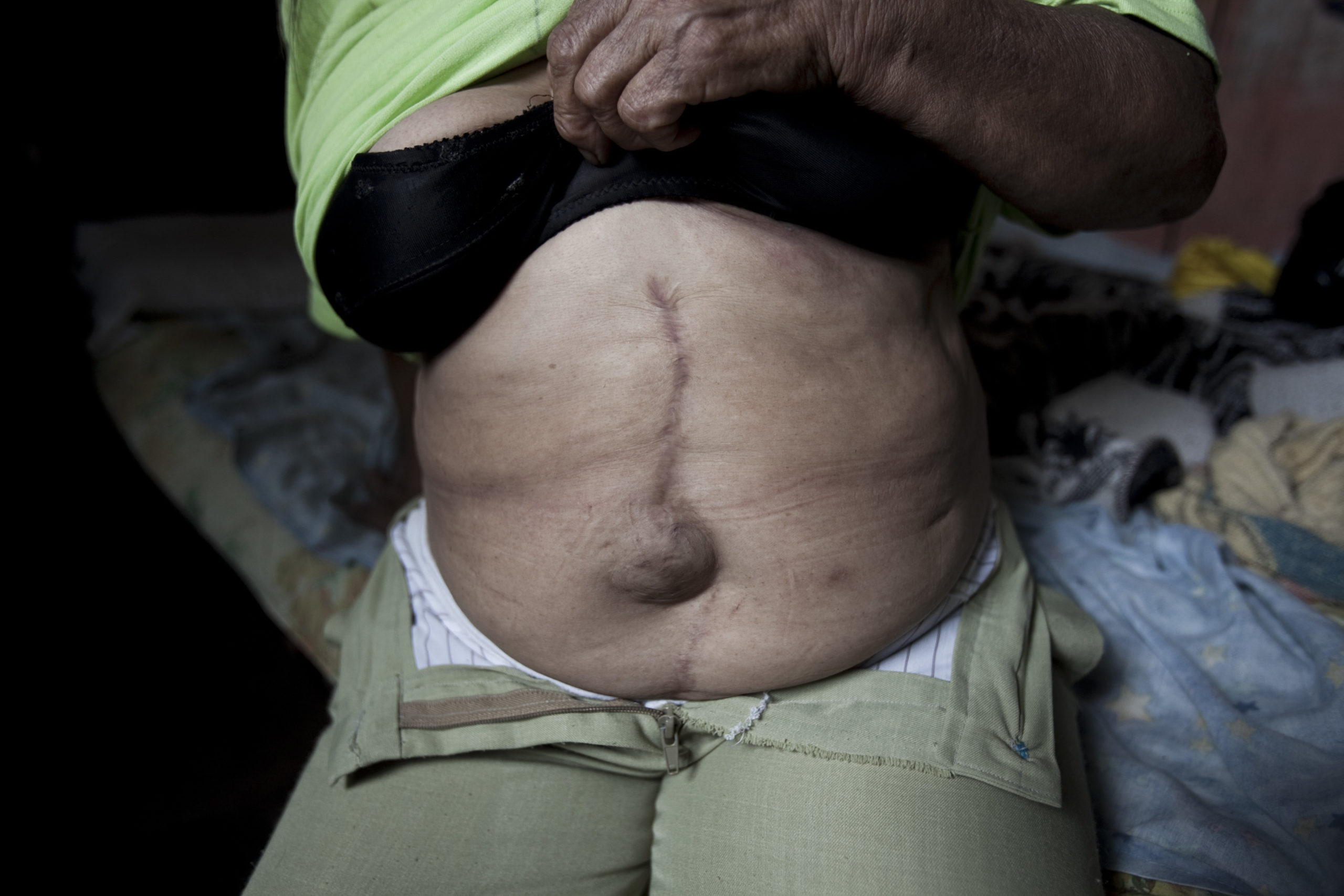 In a photo from 2010, Alba Cueran Pozos, then 65, shows the scars from cancerous tumours she had removed. She lived in the contaminated area of the rainforest for over 40 years.  (Photo: Amazon Watch)
