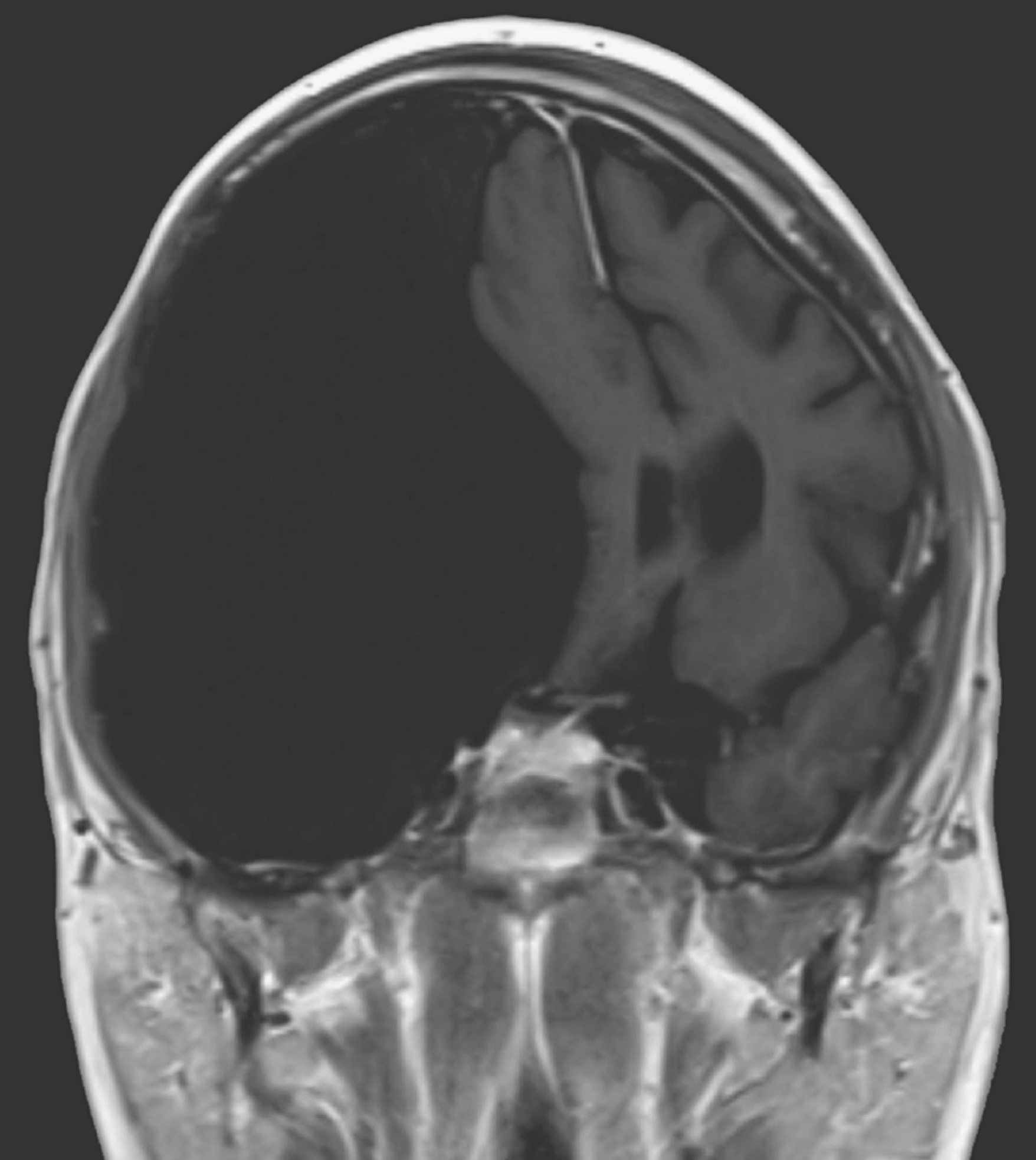 Leggett's arachnoid cyst is thought to be one of the largest ever recorded by doctors.  (Image: Jennifer de Longpre, New England Journal of Medicine)