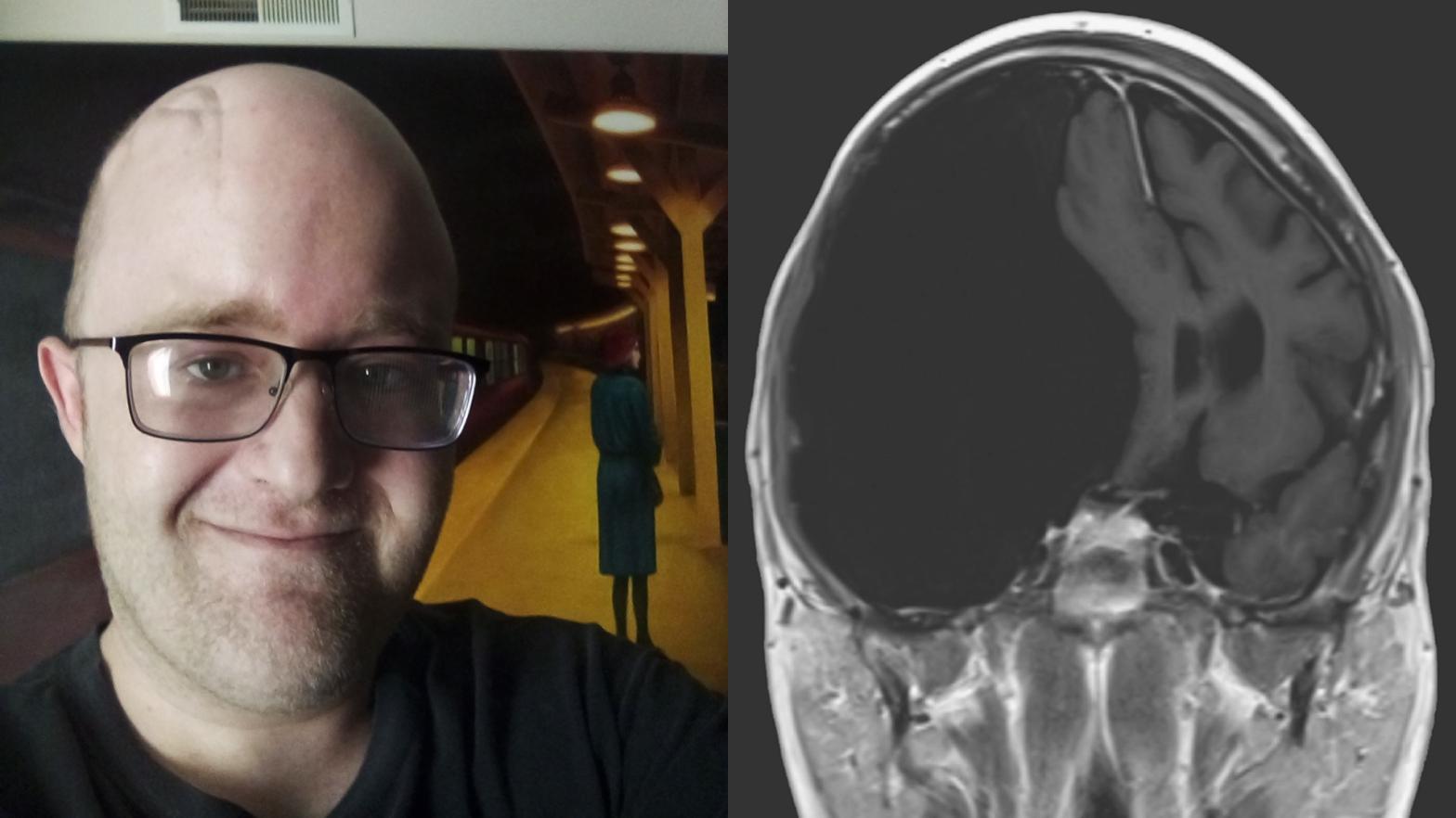 Tyler Leggett in August 2020 (left); the MRI scan of his brain that revealed the large cyst, taken in 2016 (right). Leggett's doctors say the cyst has not changed in size since then.  (Image: Tyler Leggett)