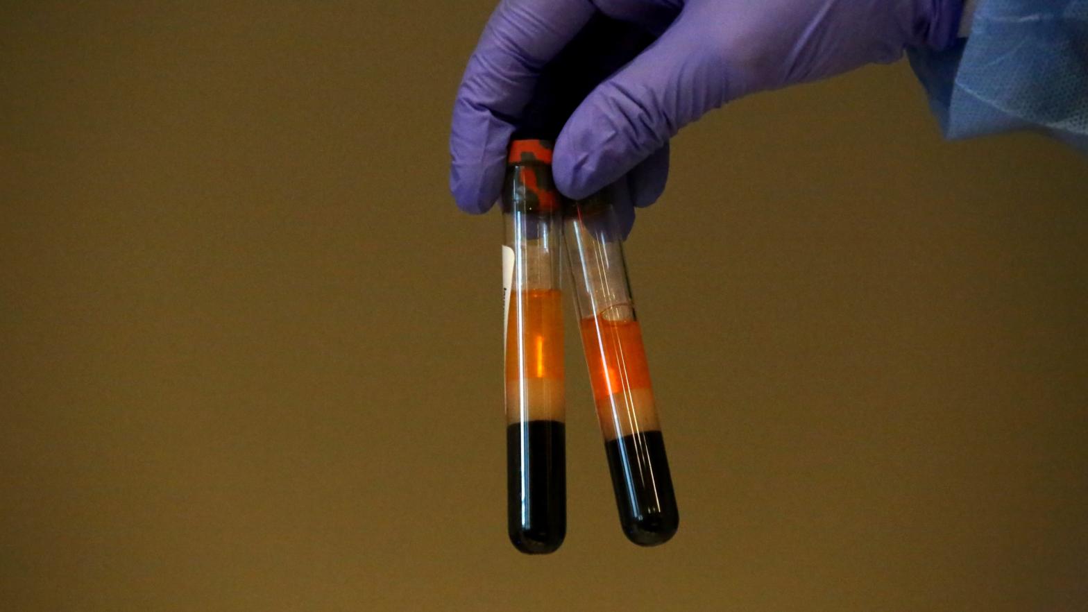 Patient samples to be tested for coronavirus antibodies. (Photo: Yana Paskova, Getty Images)