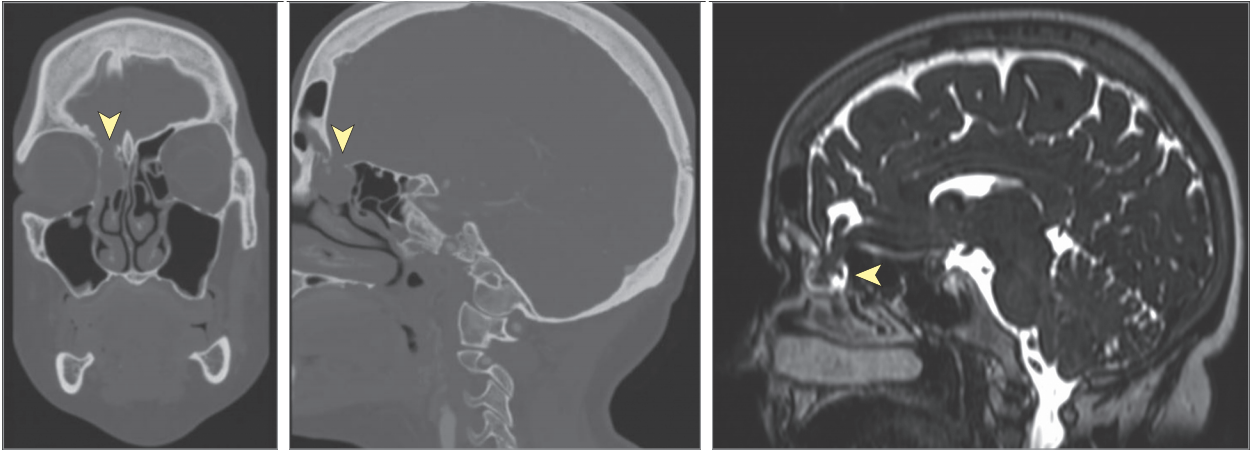 A CT scan of the woman's brain taken in 2017 did reveal her rare birth defect, but it wasn't noticed until after a nasal swab test for covid-19 likely injured it and caused spinal fluid to leak out.  (Screenshot: Sullivan, et al/JAMA Otolaryngology–Head & Neck Surgery)