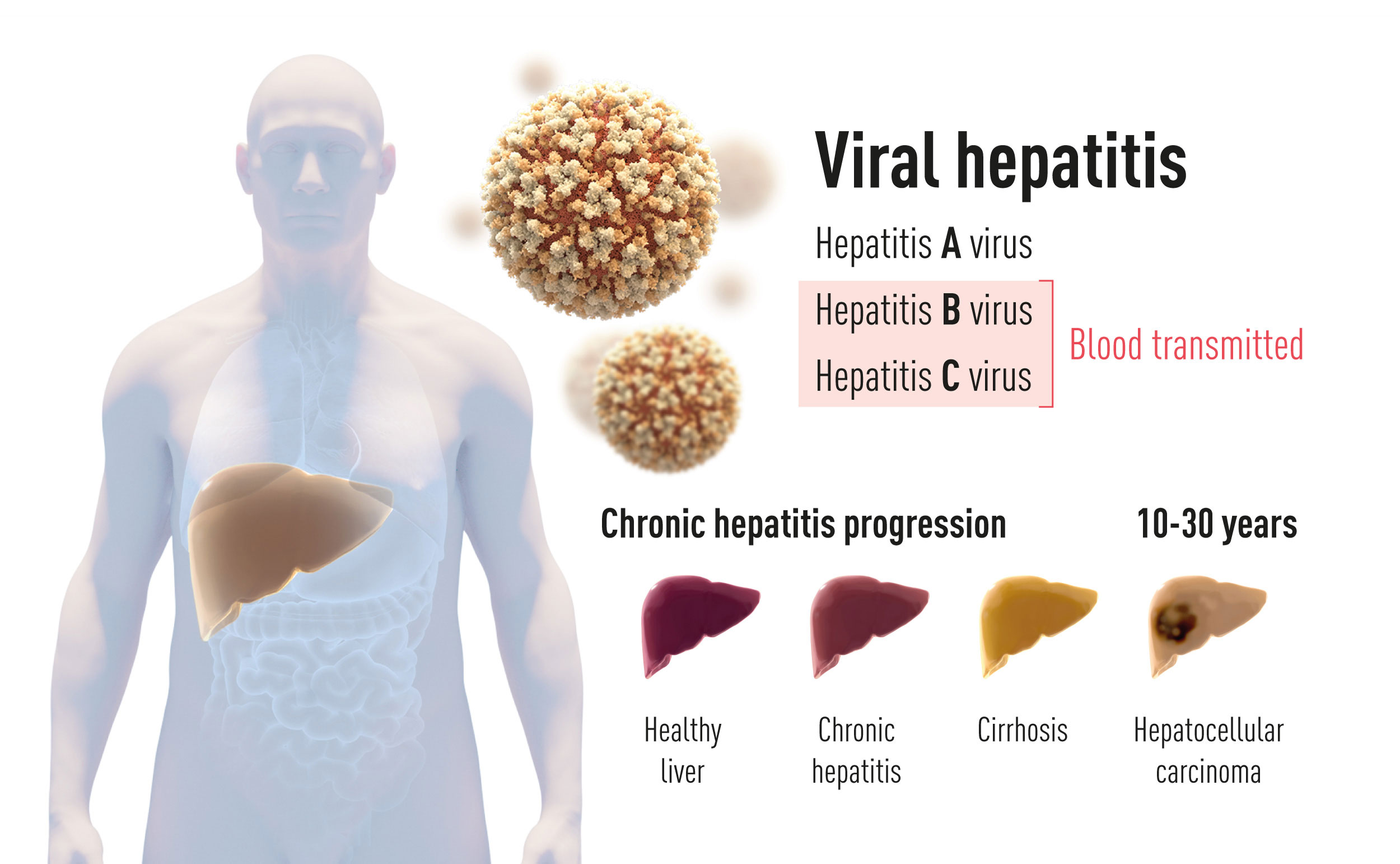 There are two main forms of hepatitis virus, one that spreads through food and water (type A) and two kinds that are blood-borne (types B and C).  (Image: Nobel Media)