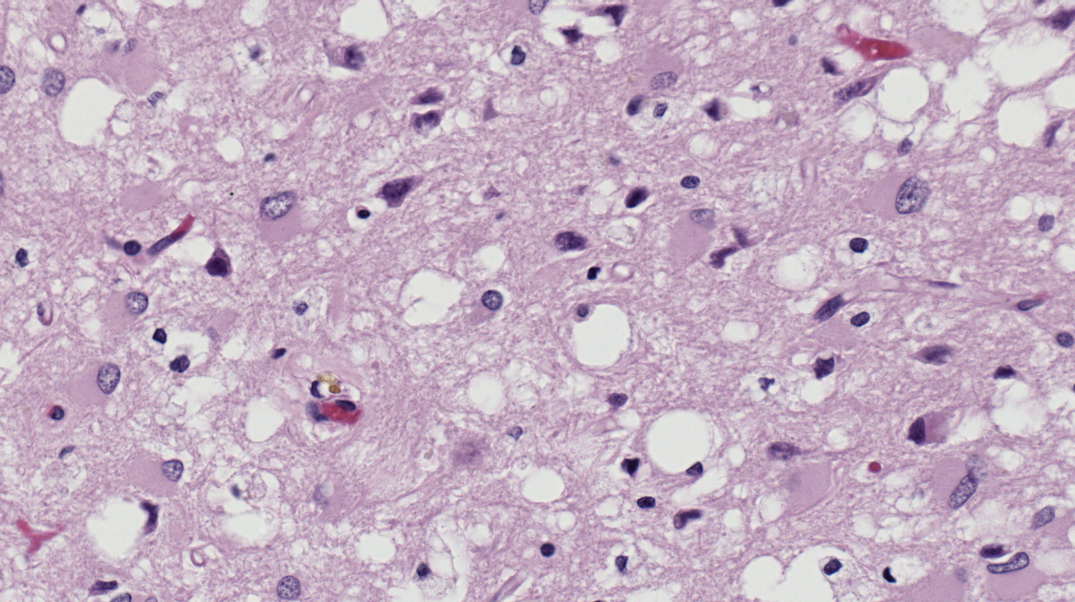 An image of a human brain tissue specimen under a microscope. It displays the telltale spongy holes caused by Creutzfeldt-Jakob disease. (Image: Sherif Zaki, Wun-Ju Shieh/CDC)