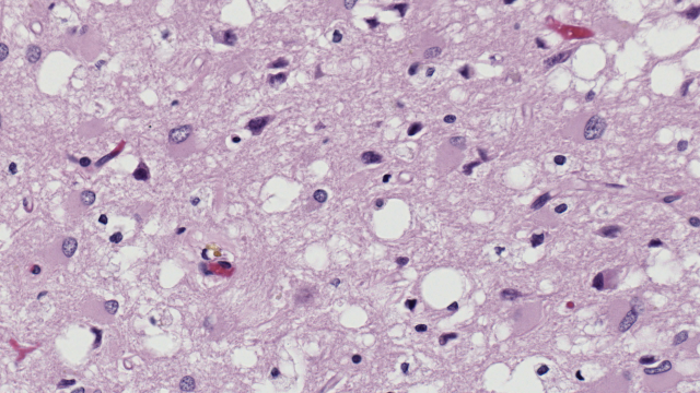 A Brain-Destroying Prion Disease Is Becoming More Common, Study Finds