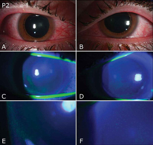 Slit-lamp photography of both eyes of one patient who developed inflamed corneas after exposure to a UV lamp. (Image: Sengillo, et al/Ocular Immunology and Inflammation)