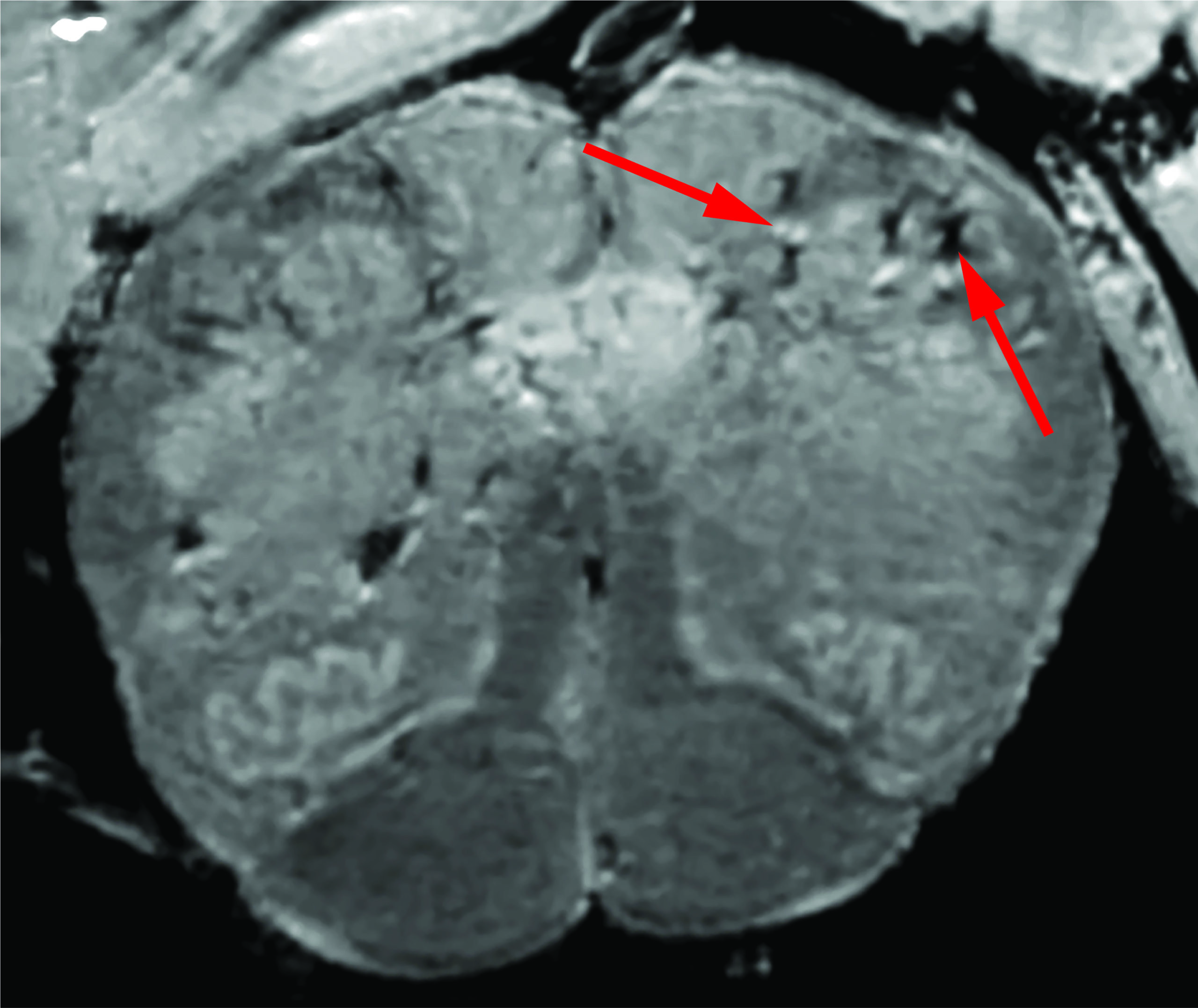 A high-resolution scan of a covid-19 patient's brain stem. The arrows point to light and dark spots that suggest blood vessel damage. (Image: Courtesy of NIH/NINDS)