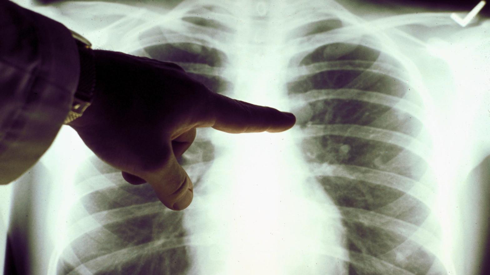 A doctor pointing to the lung X-ray of a cigarette smoker (Photo: American Cancer Society, Getty Images)
