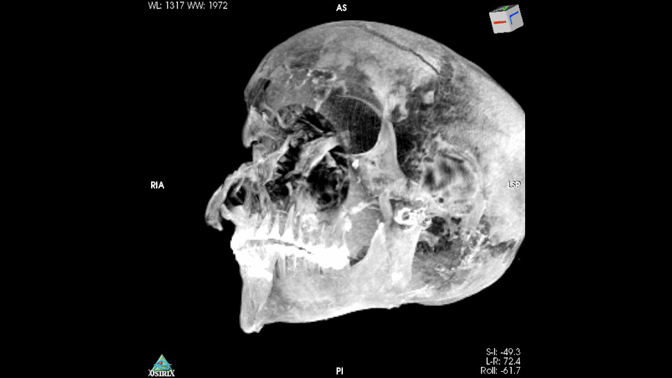 3D image showing the pharaoh's badly damaged skull.  (Image: Sahar Saleem)