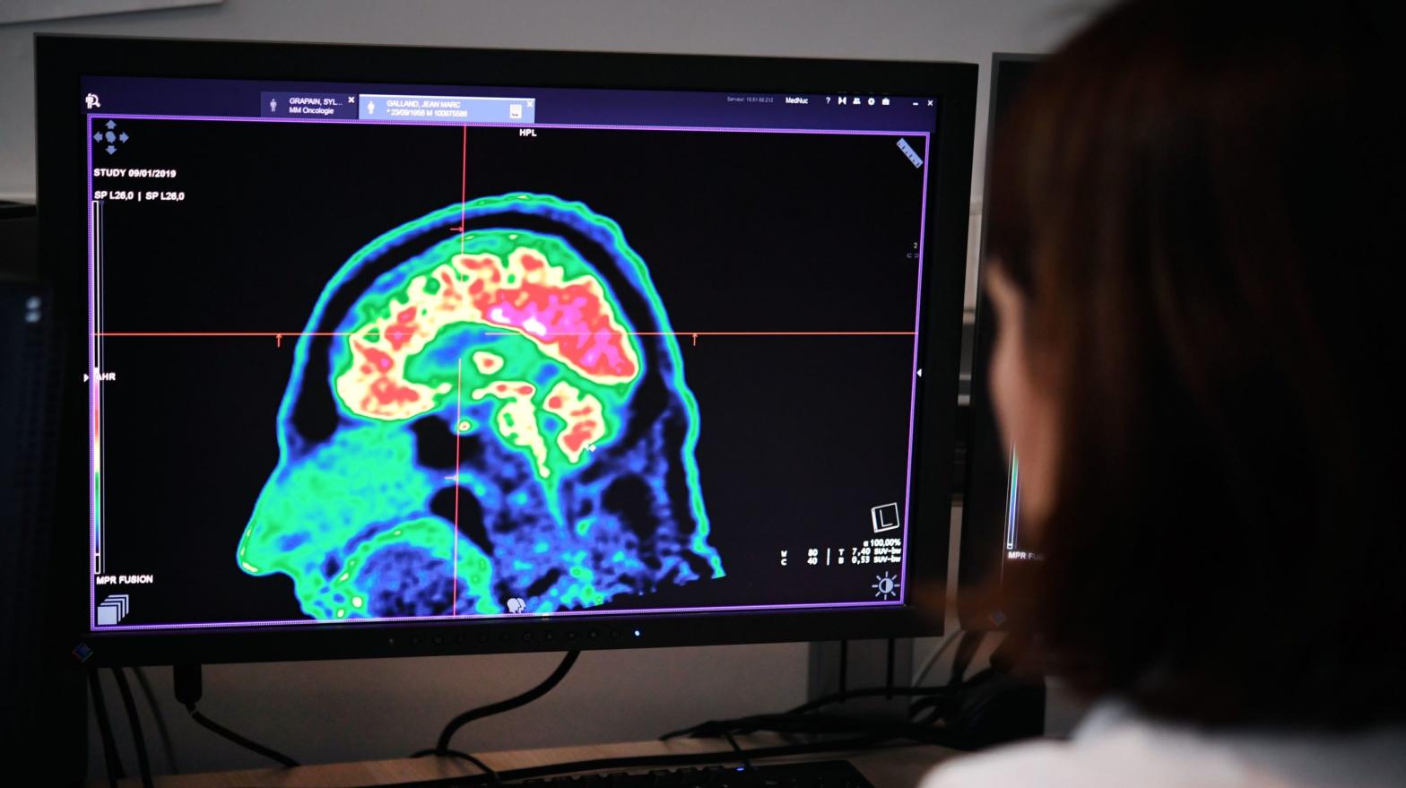 A doctor looking at a picture of a human brain taken by a positron emission tomography scanner, also called PET scan, on Jan. 9, 2019, at the Regional and University Hospital Centre of Brest in France.  (Photo: Fred Tanneau, Getty Images)