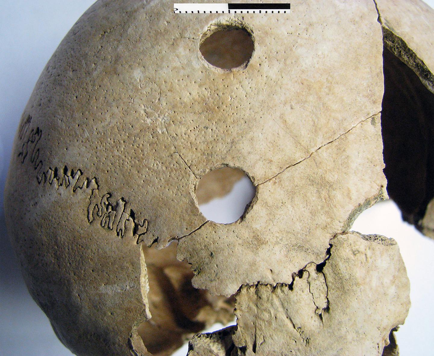 Penetrating wounds found on the skull of a young adult female.  (Image: Mario Novak, Institute for Anthropological Research)
