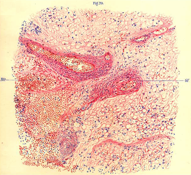 An illustration of brain tissue seen under a microscope that was collected from a monkey said to have encephalitis lethargica. The image was included in a book about the condition written by Austrian neurologist Constantin von Economo, who discovered it.  (Photo: Constantin von Economo, Fair Use)