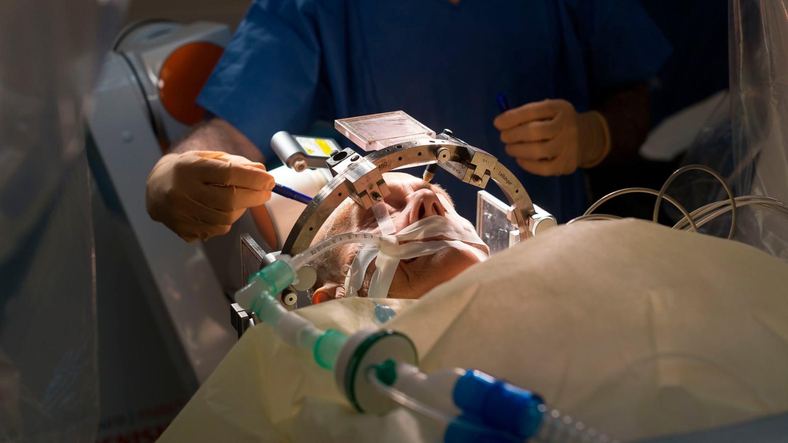 Stereotactic Neurosurgery operation, Pasteur 2 Hospital, Nice, France. A patient with Parkinsons disease is being treated with deep brain stimulation by implanting electrodes in brain and modulating cerebral electrical activity. (Photo: BSIP/Universal Images Group, Getty Images)