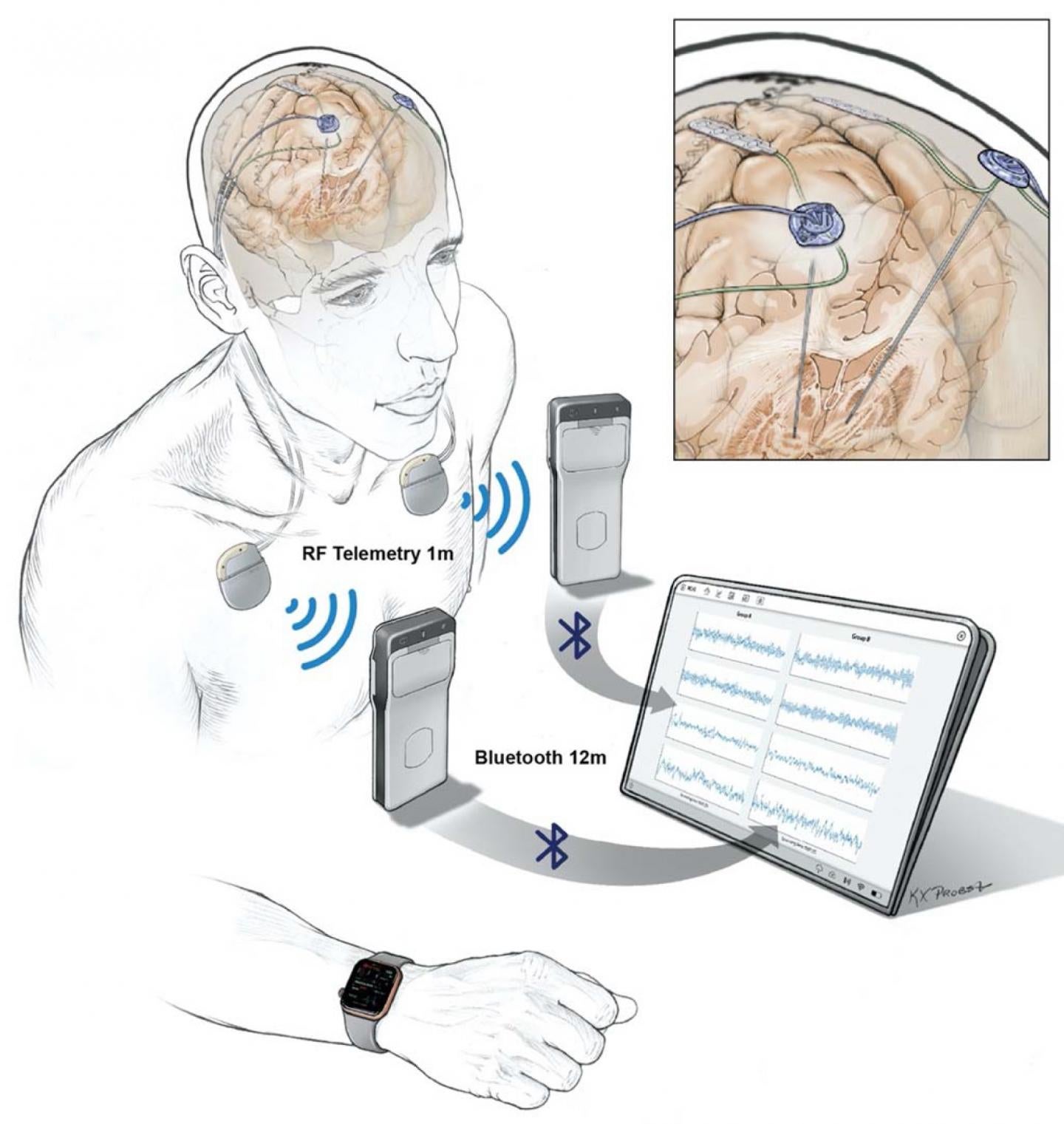 Implanted electrodes stream recorded data to a pocket-sized device worn by a patient. The data is then wirelessly transferred to a tablet and uploaded to the cloud via a HIPAA-compliant server. (Illustration: Starr lab/UCSF)