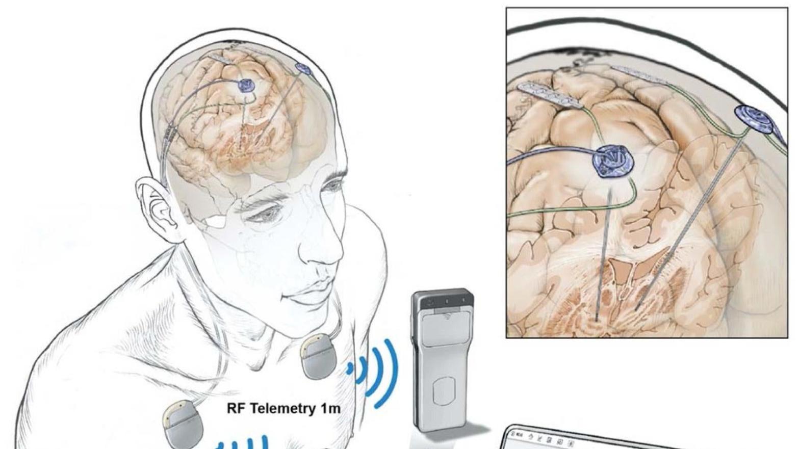 An illustration of the team's wireless deep brain stimulation technology.  (Illustration: Starr lab, UCSF)