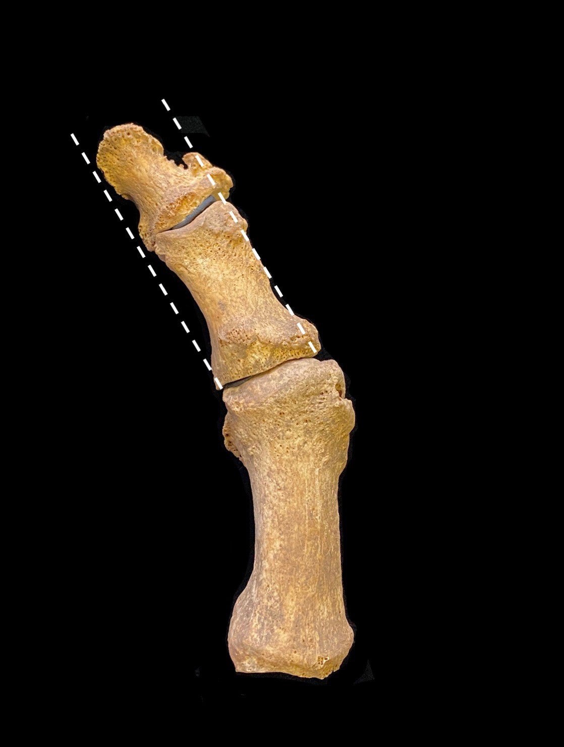 A deviated medieval toe, suggesting the individual suffered from bunions. (Image: Jenna Dittmar)