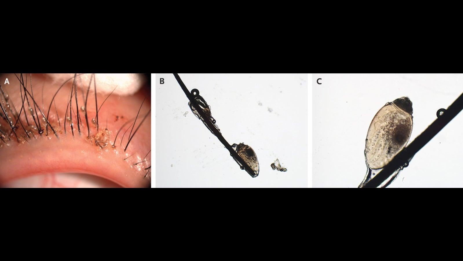 Images of the patient's lice captured via slit-lamp examination (A) and via a microscope (B and C) (Image: Xue Feng and Hong Qi/© The New England Journal of Medicine (2021))