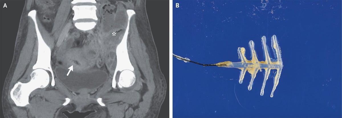 The left image is a CT scan taken of the patient, with the arrow pointing to her IUD and the asterisk denoting an nearby abscess. The right image is of the IUD after removal, with the yellow substance thought to be the bacteria that caused her infection. (Image: Noriko Arakaki and Yusuke Oshiro/NEJM)