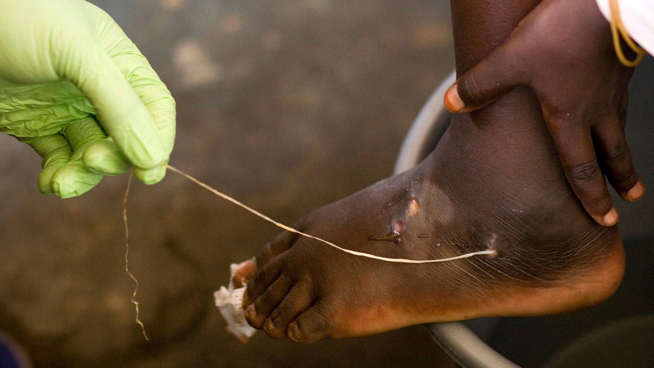 A Guinea worm being extracted from a child's foot at a containment centre in Savelugu, Ghana in a March 2007 photo. The worm found in the Vietnam case was a related species, possibly native to reptiles. (Photo: Olivier Asselin, AP)
