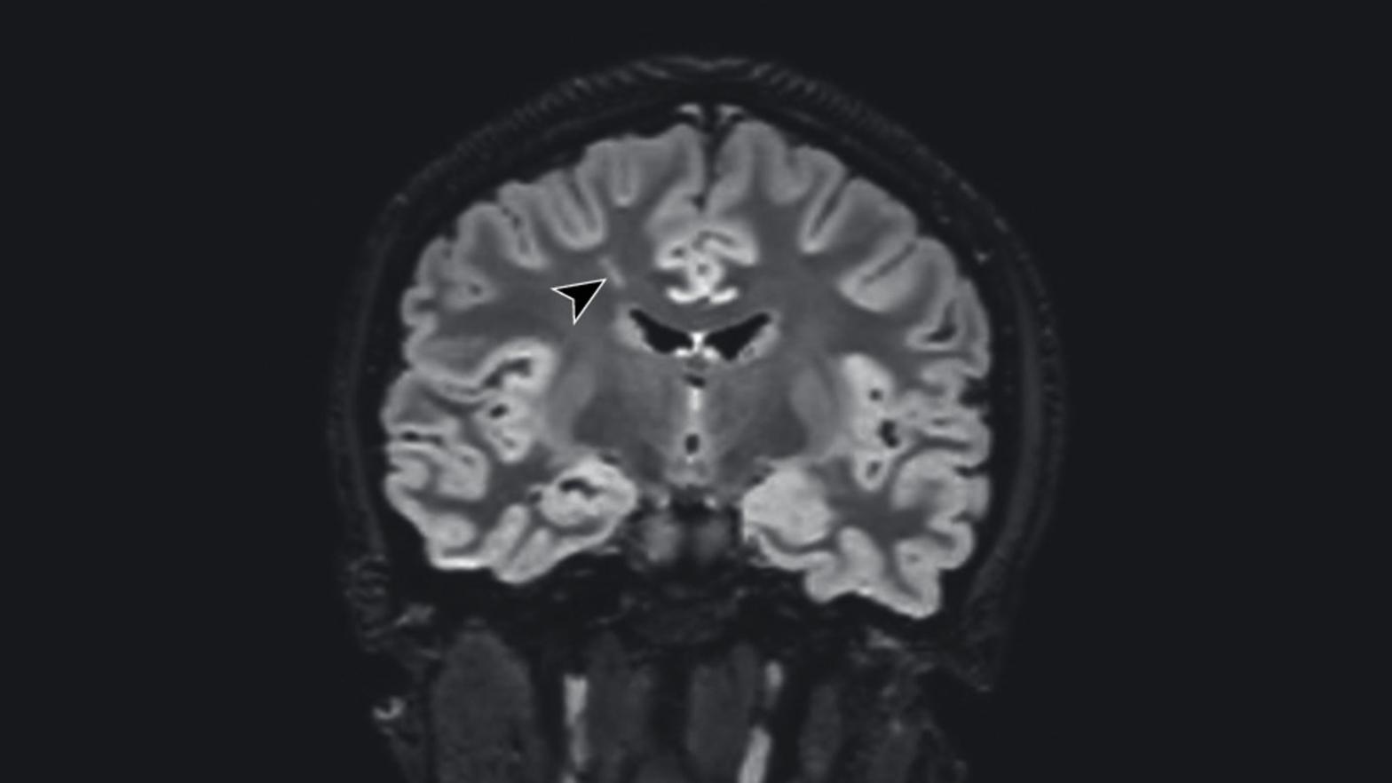 A MRI scan of one of the patients, with the arrow pointing to a suspected lesion.  (Photo: Bartley CM, et al/JAMA Neurology)
