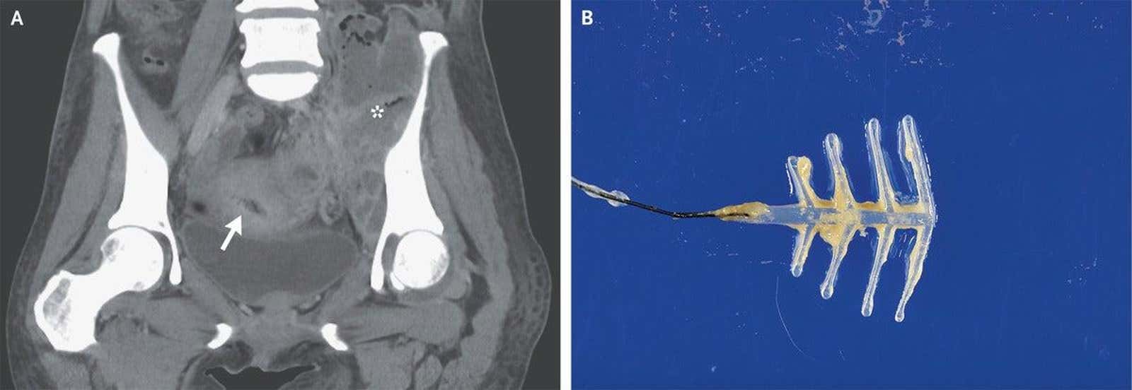The left image is a CT scan taken of the patient, with the arrow pointing to her IUD and the asterisk denoting an nearby abscess. The right image is of the IUD after removal, with the yellow substance thought to be the bacteria that caused her infection. (Photo: Noriko Arakaki and Yusuke Oshiro/NEJM)