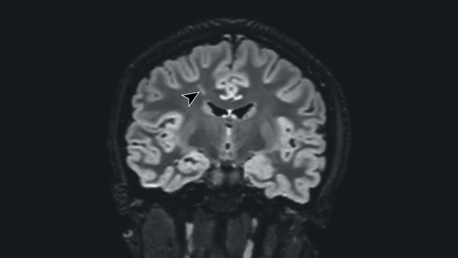 A MRI scan of one of the patients, with the arrow pointing to a suspected lesion. (Image: Bartley CM, et al/JAMA Neurology)