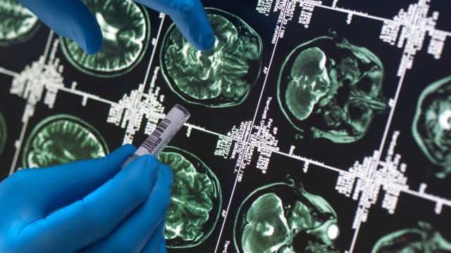 Frightening New Details Emerge About Mystery Brain Illness in Canada