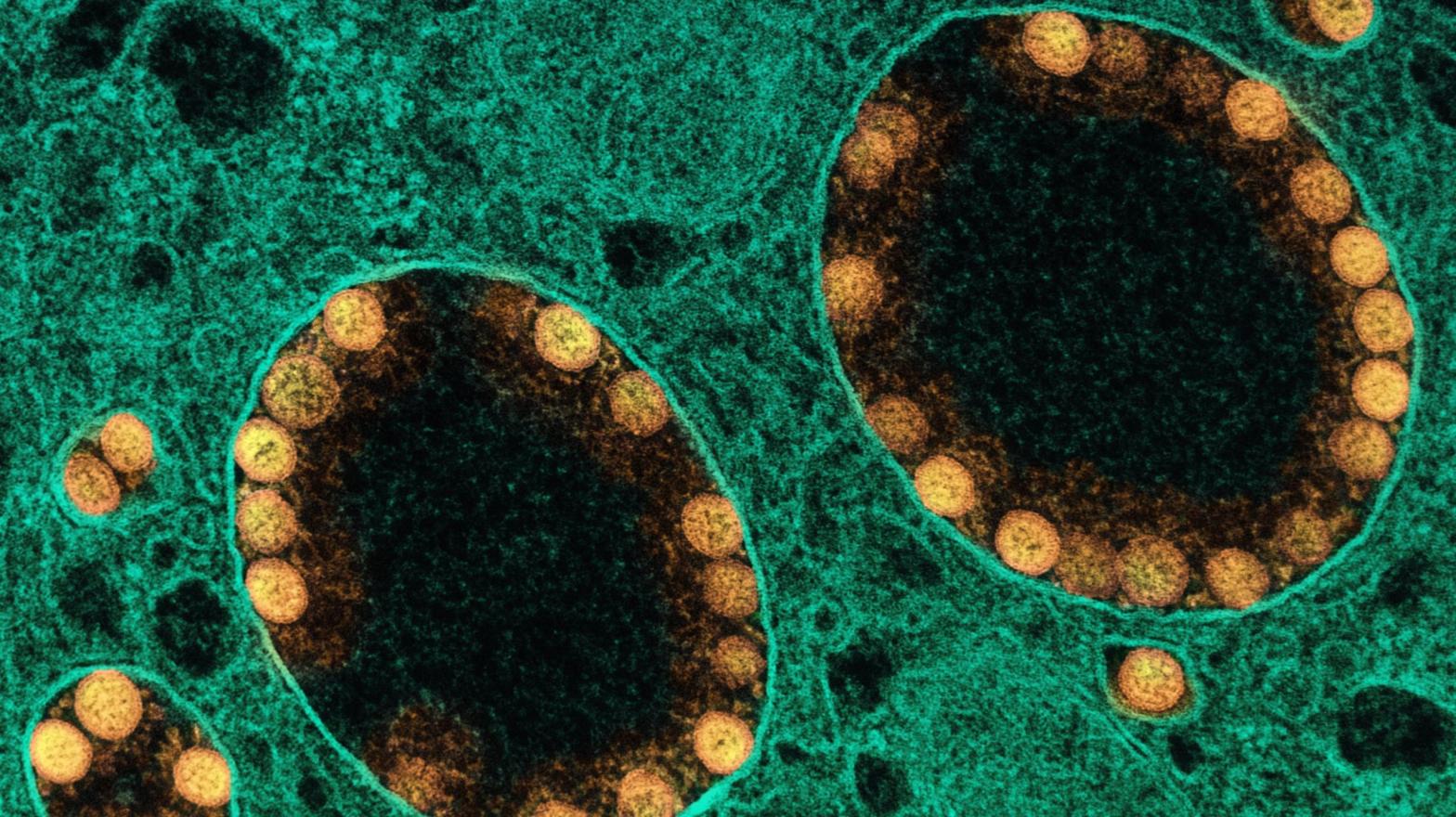 A transmission electron micrograph of SARS-CoV-2 virus particles (in gold) within endosomes of a heavily infected nasal olfactory epithelial cell. (Photo: NIH/NAID/IMAGE.FR/BSIP/Universal Images Group, Getty Images)