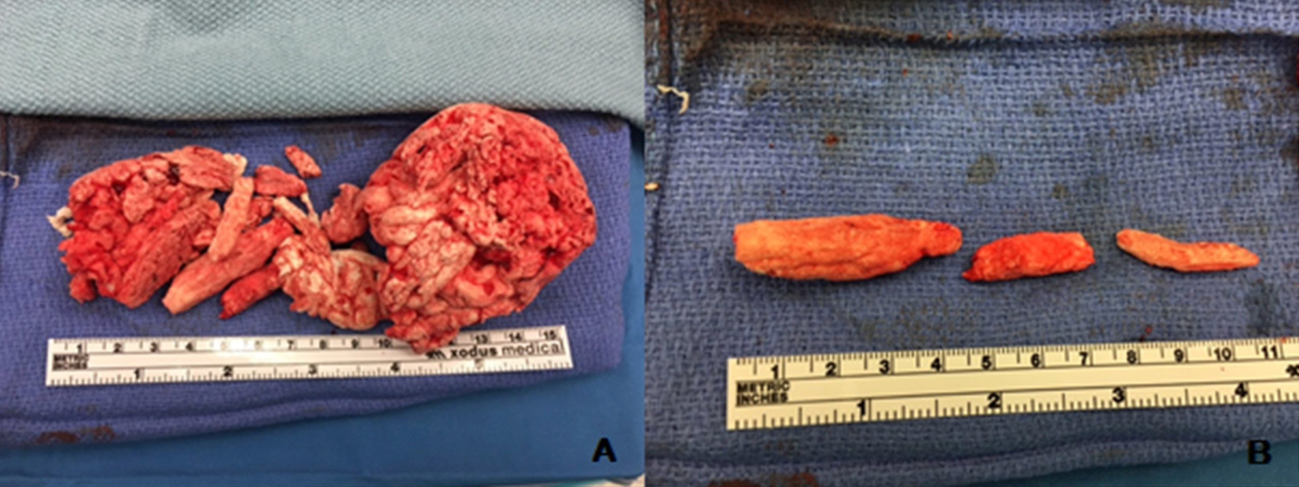 The foam removed from the man's bladder and urethra.  (Photo: RosaPark, Susan M.MacDonald/Urology Case Reports)